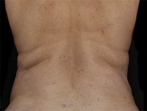 Coolsculpting Before and After | Little Lipo