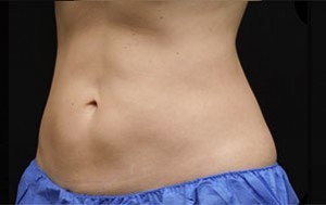 Coolsculpting Before and After | Little Lipo