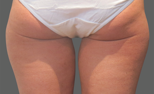 Coolsculpting Before and After | Little Lipo