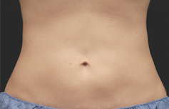 Coolsculpting Before and After | Little Lipo