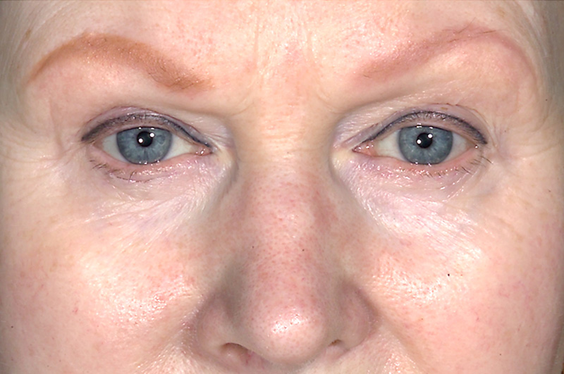 Eyelid Surgery Before and After | Little Lipo