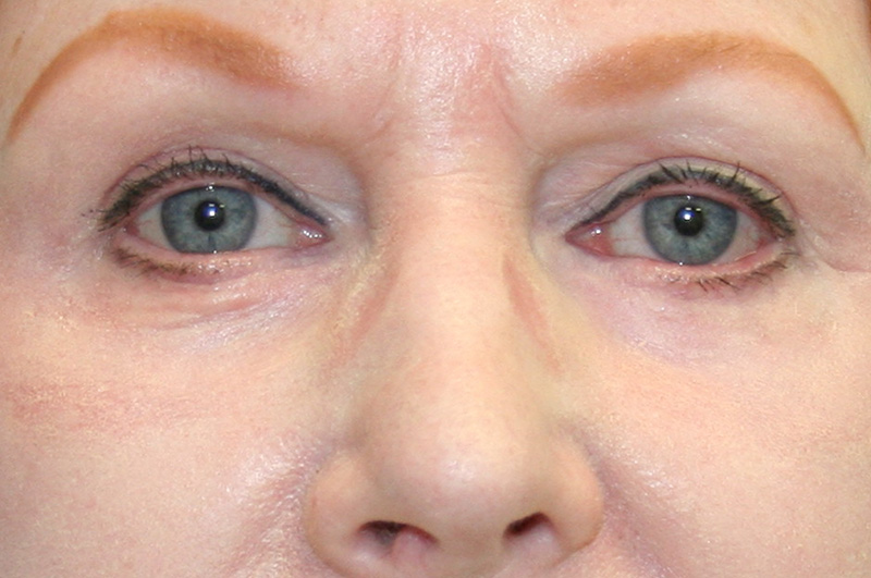 Eyelid Surgery Before and After | Little Lipo