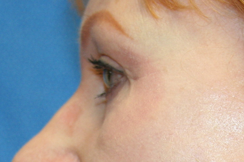 Eyelid Surgery Before and After | Little Lipo