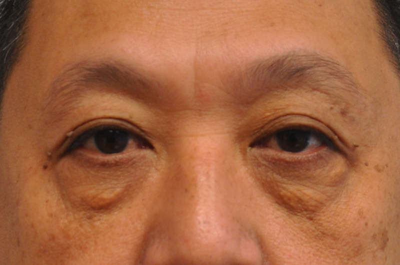 Eyelid Surgery Before and After | Little Lipo