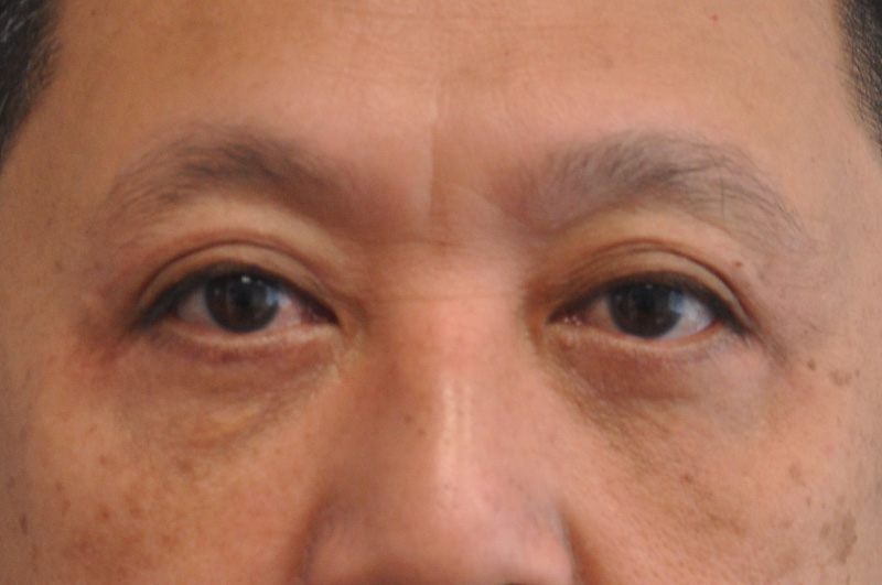 Eyelid Surgery Before and After | Little Lipo