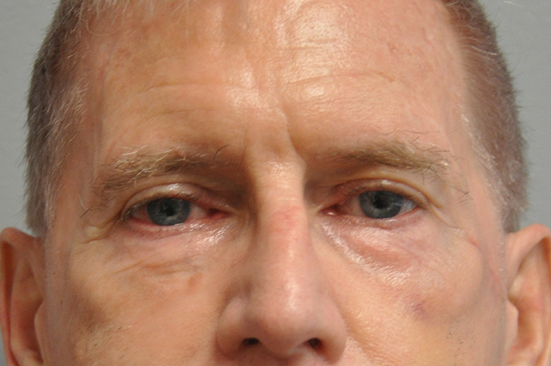 Eyelid Surgery Before and After | Little Lipo