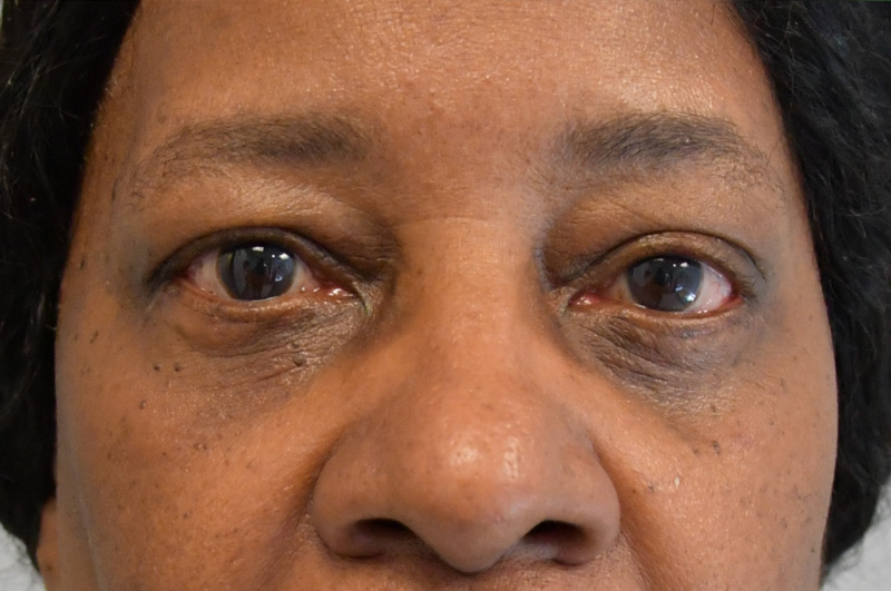 Eyelid Surgery Before and After | Little Lipo