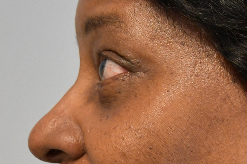 Eyelid Surgery Before and After | Little Lipo