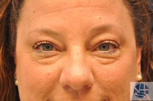 Eyelid Surgery Before and After | Little Lipo