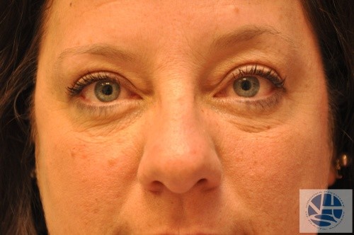 Eyelid Surgery Before and After | Little Lipo