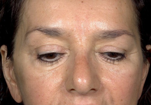 Eyelid Surgery Before and After | Little Lipo