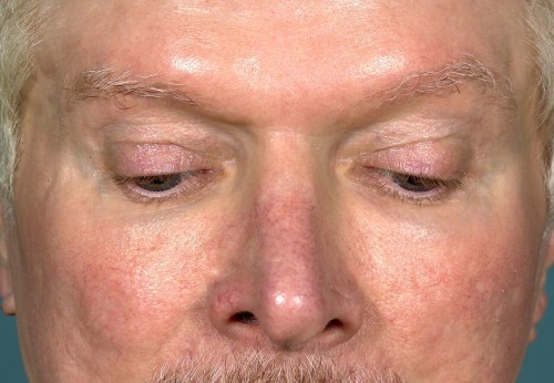 Eyelid Surgery Before and After | Little Lipo