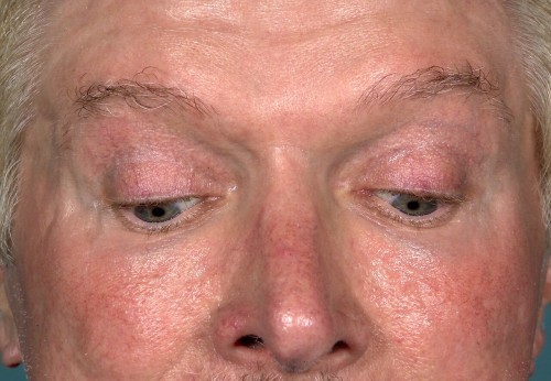 Eyelid Surgery Before and After | Little Lipo