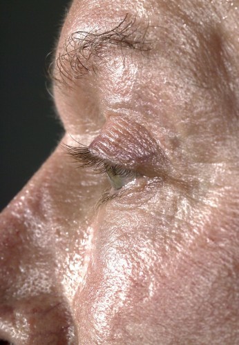 Eyelid Surgery Before and After | Little Lipo