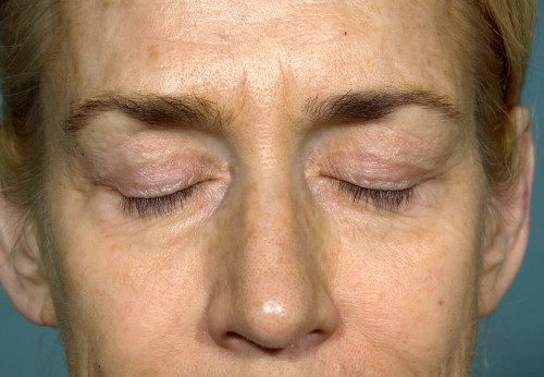 Eyelid Surgery Before and After | Little Lipo