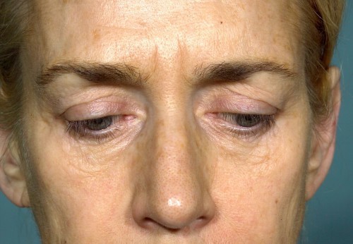 Eyelid Surgery Before and After | Little Lipo