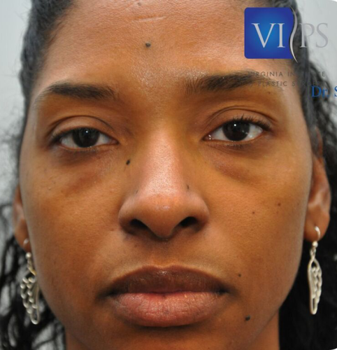 Eyelid Surgery Before and After | Little Lipo