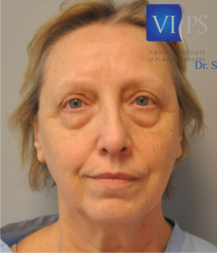 Eyelid Surgery Before and After | Little Lipo