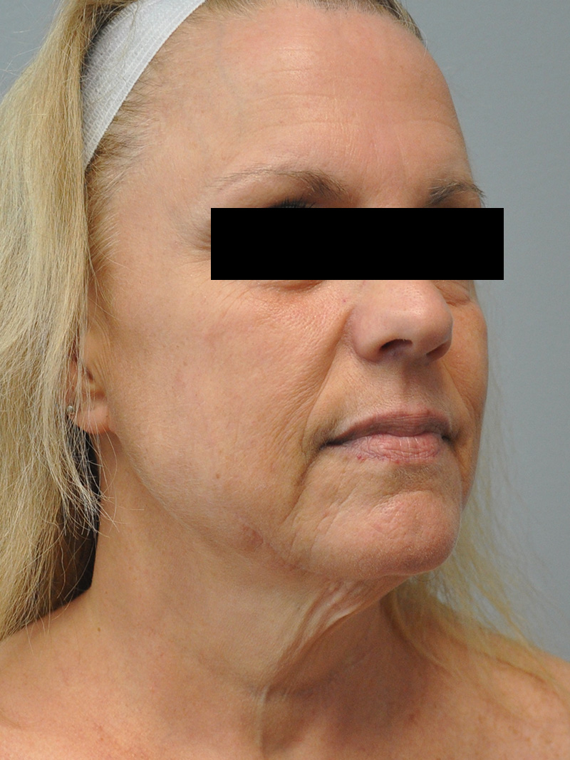 Facelift Before and After | Little Lipo