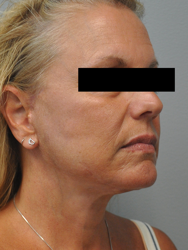 Facelift Before and After | Little Lipo