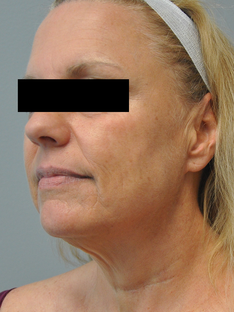 Facelift Before and After | Little Lipo