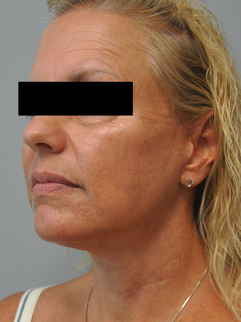 Facelift Before and After | Little Lipo