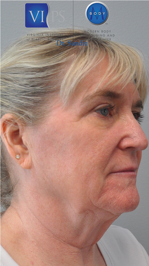 Facelift Before and After | Little Lipo