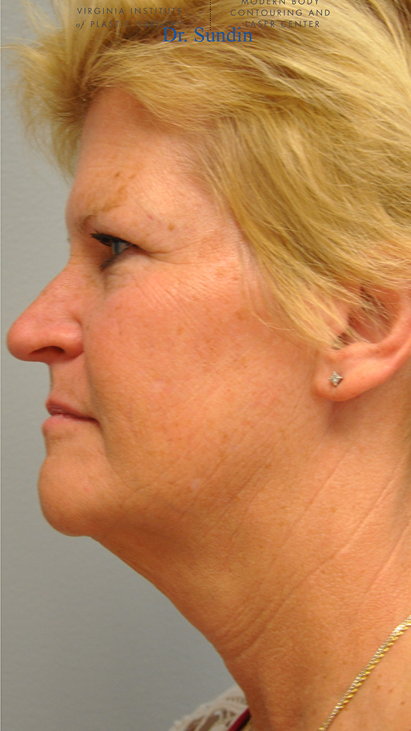 Facelift Before and After | Little Lipo