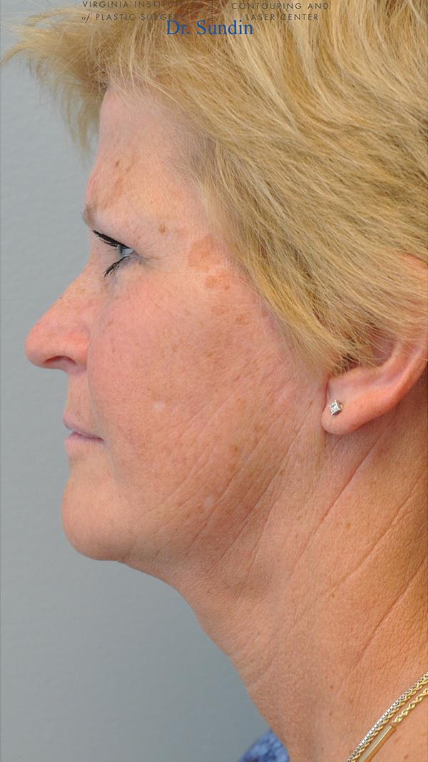 Facelift Before and After | Little Lipo