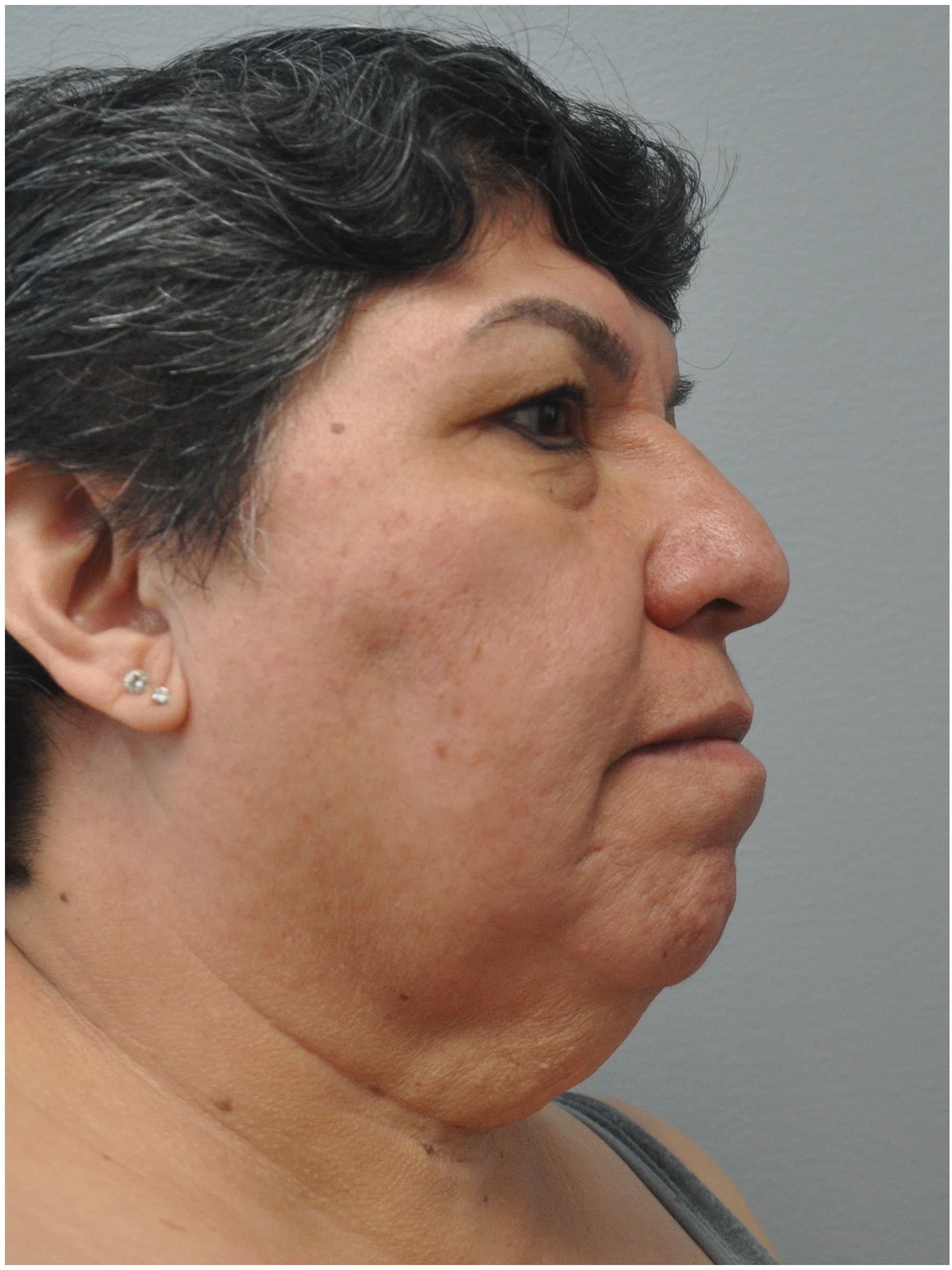 Facelift Before and After | Little Lipo