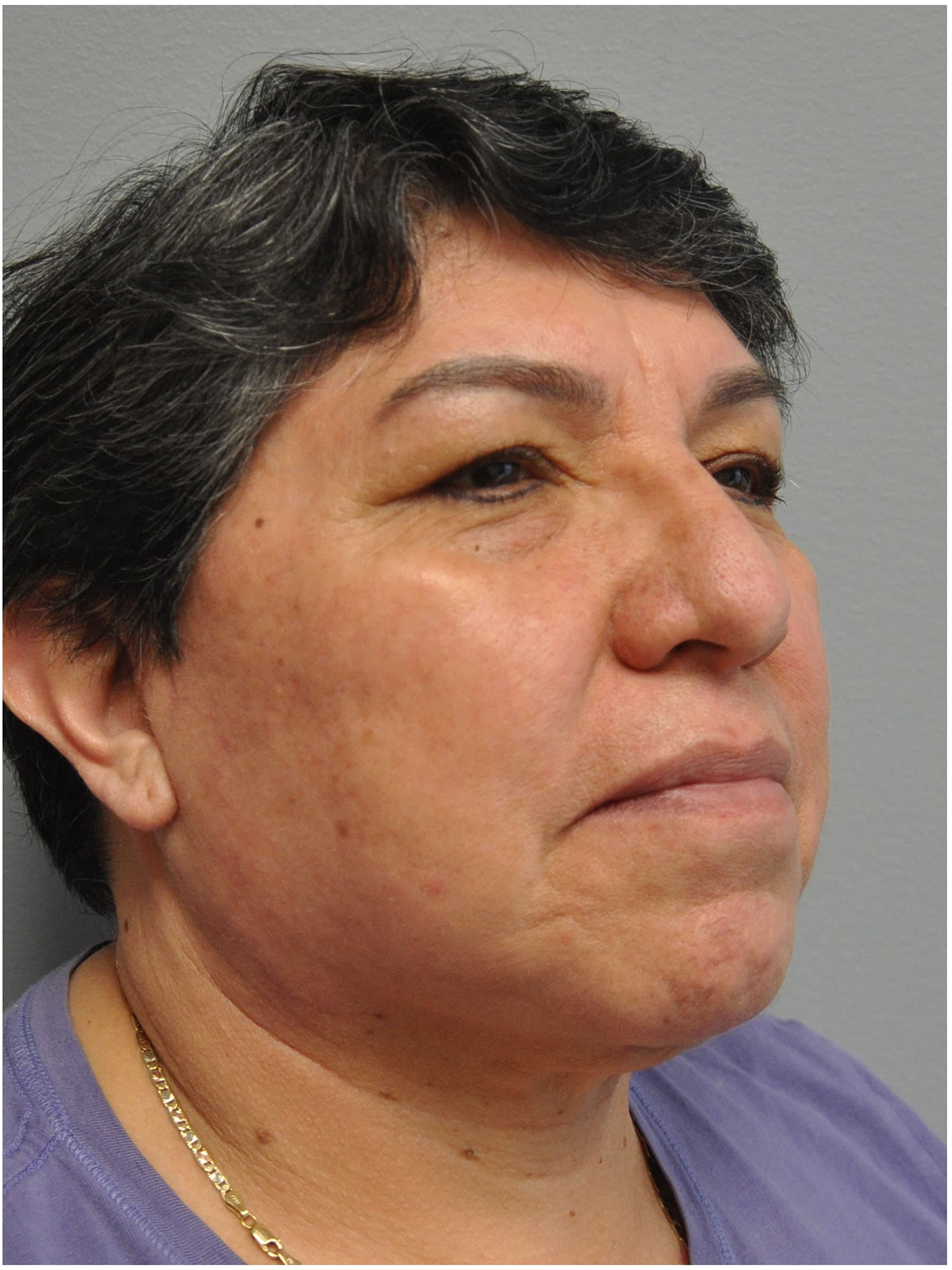 Facelift Before and After | Little Lipo