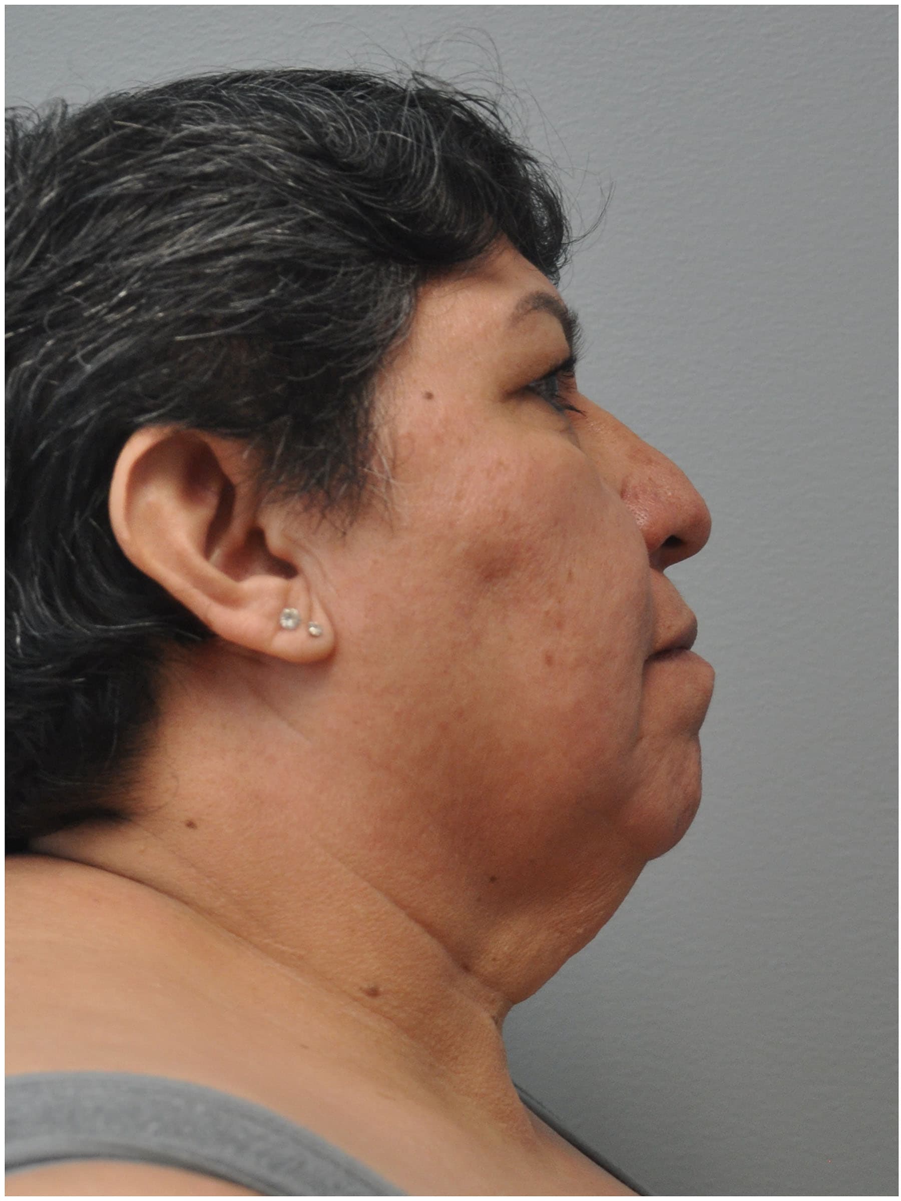 Facelift Before and After | Little Lipo