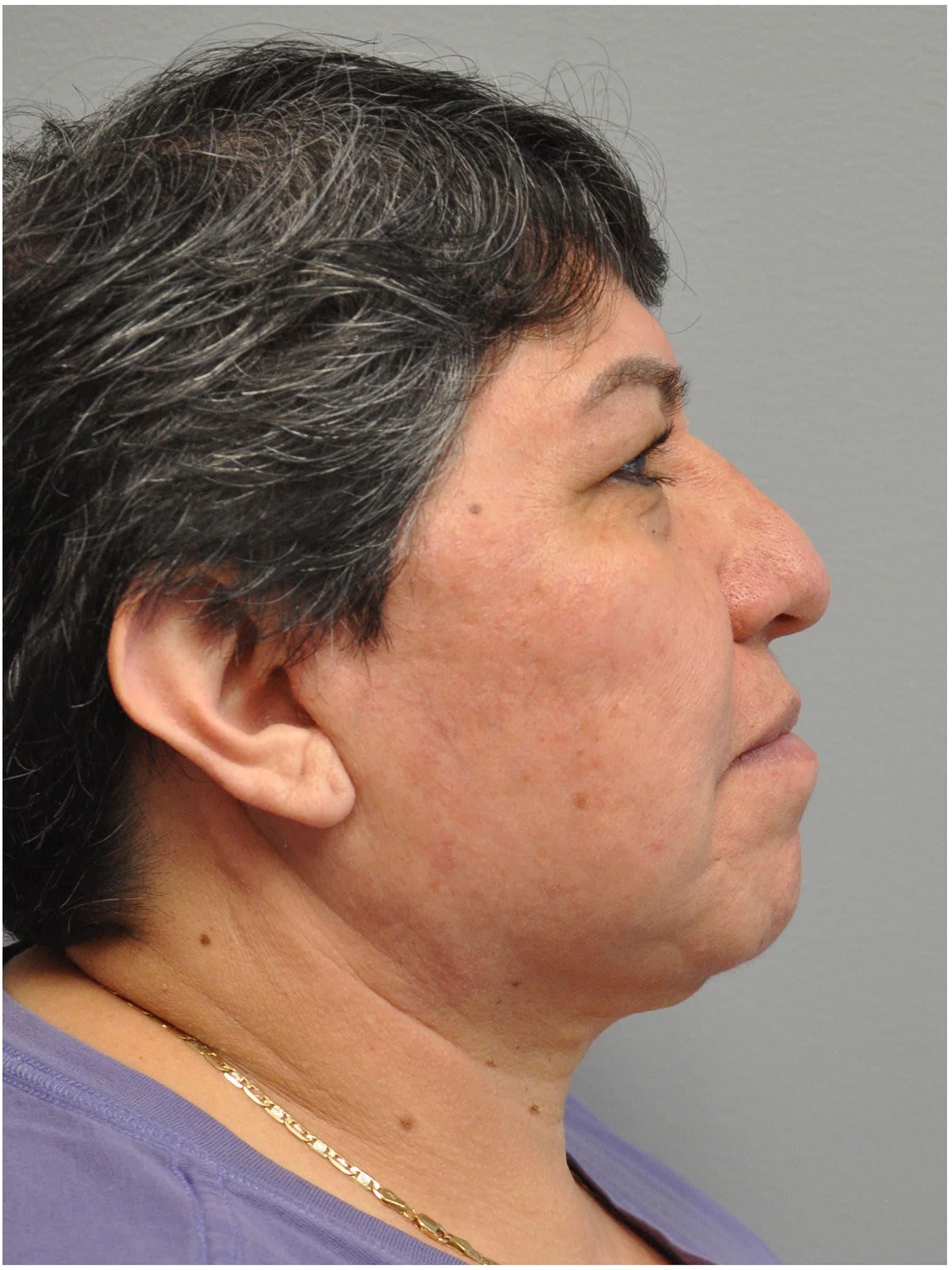 Facelift Before and After | Little Lipo