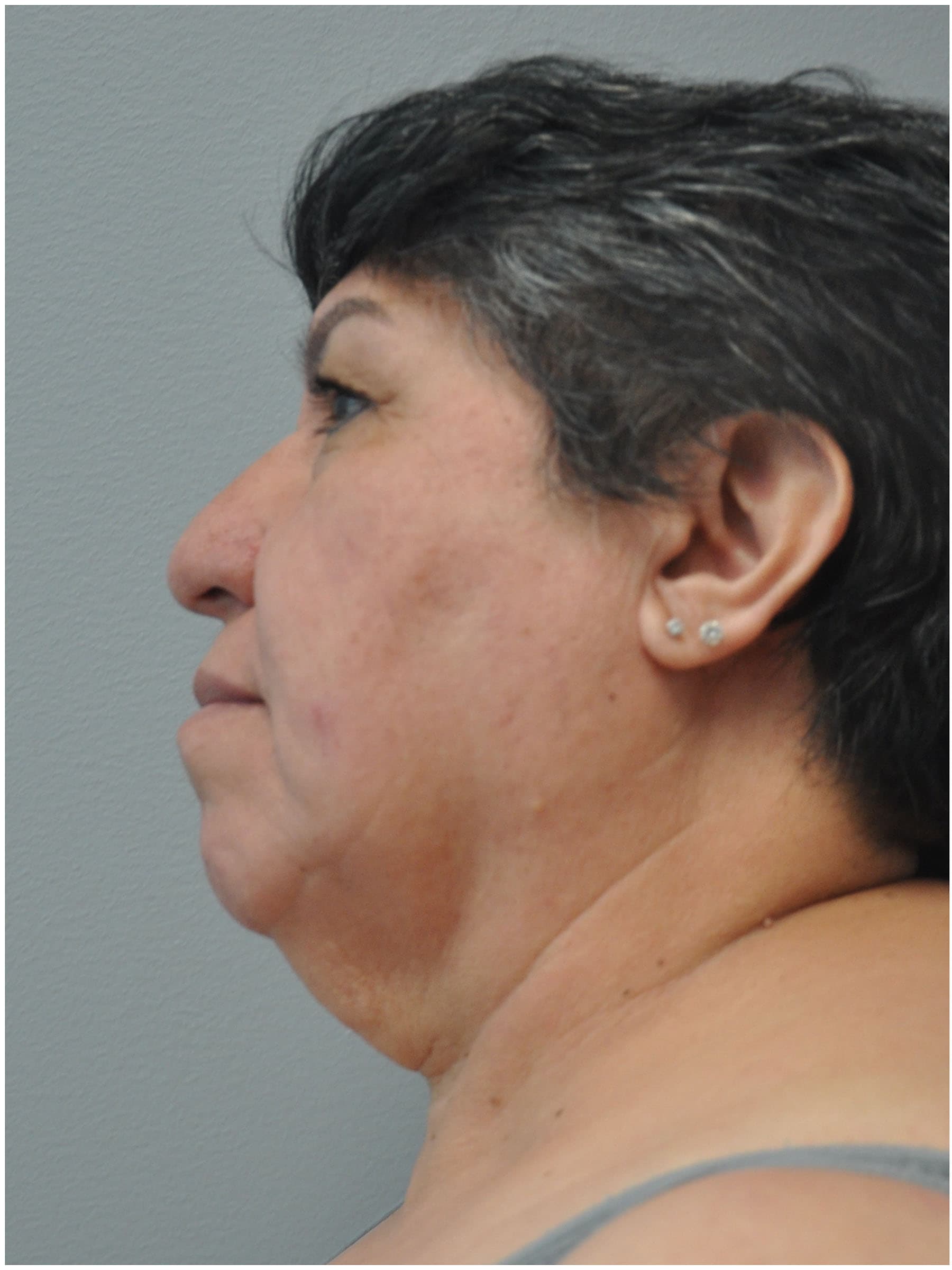Facelift Before and After | Little Lipo