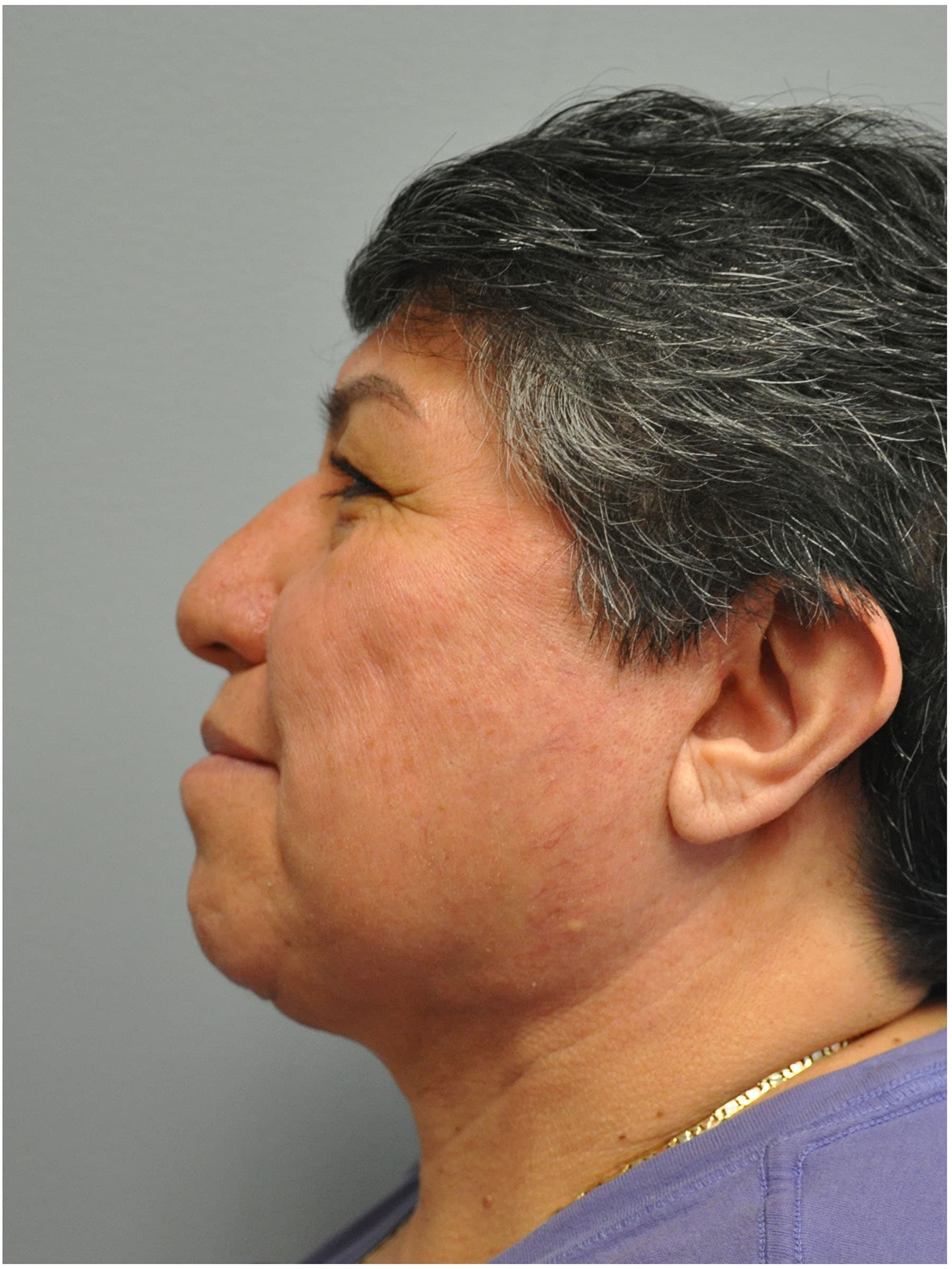 Facelift Before and After | Little Lipo