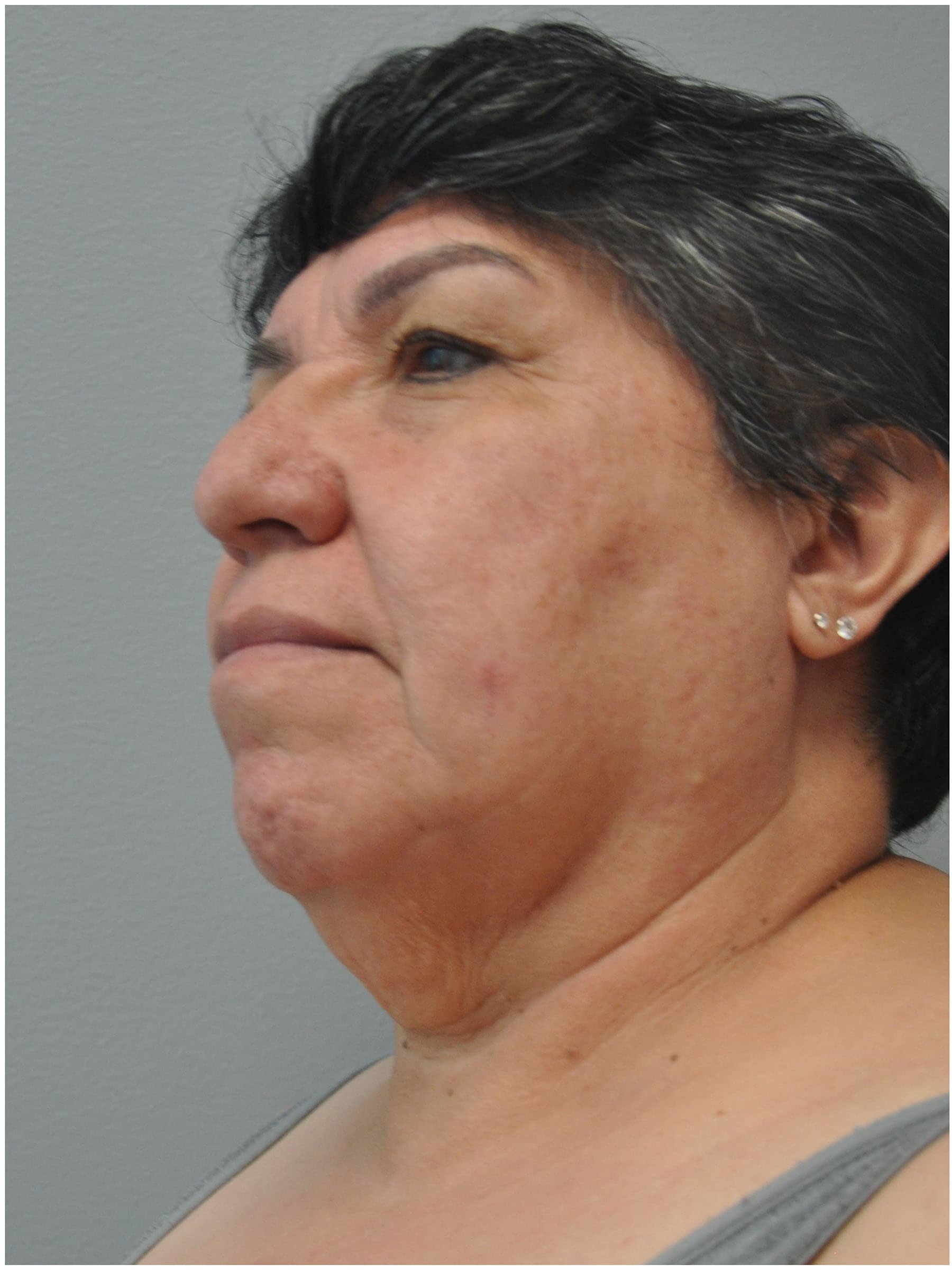 Facelift Before and After | Little Lipo