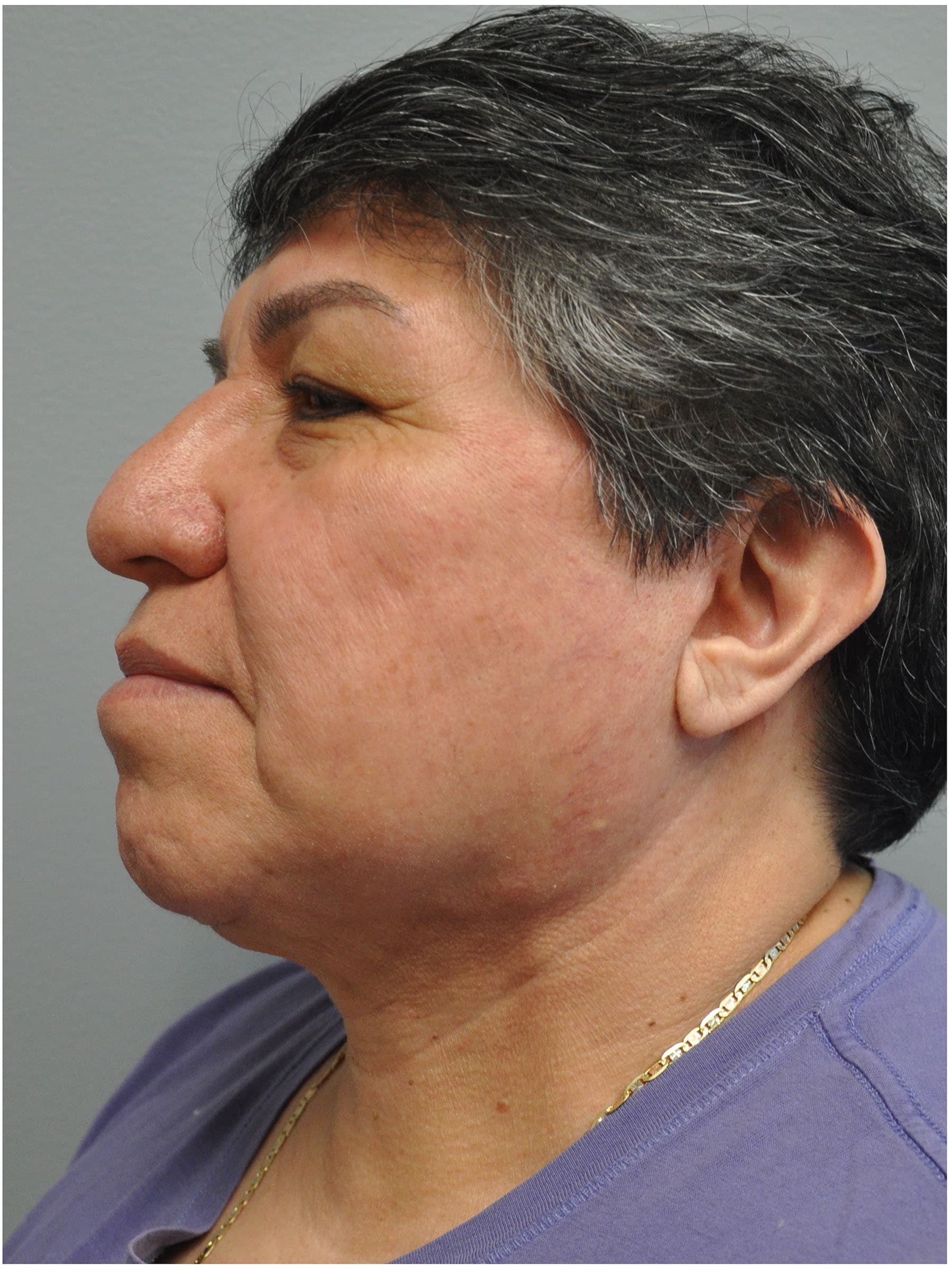 Facelift Before and After | Little Lipo