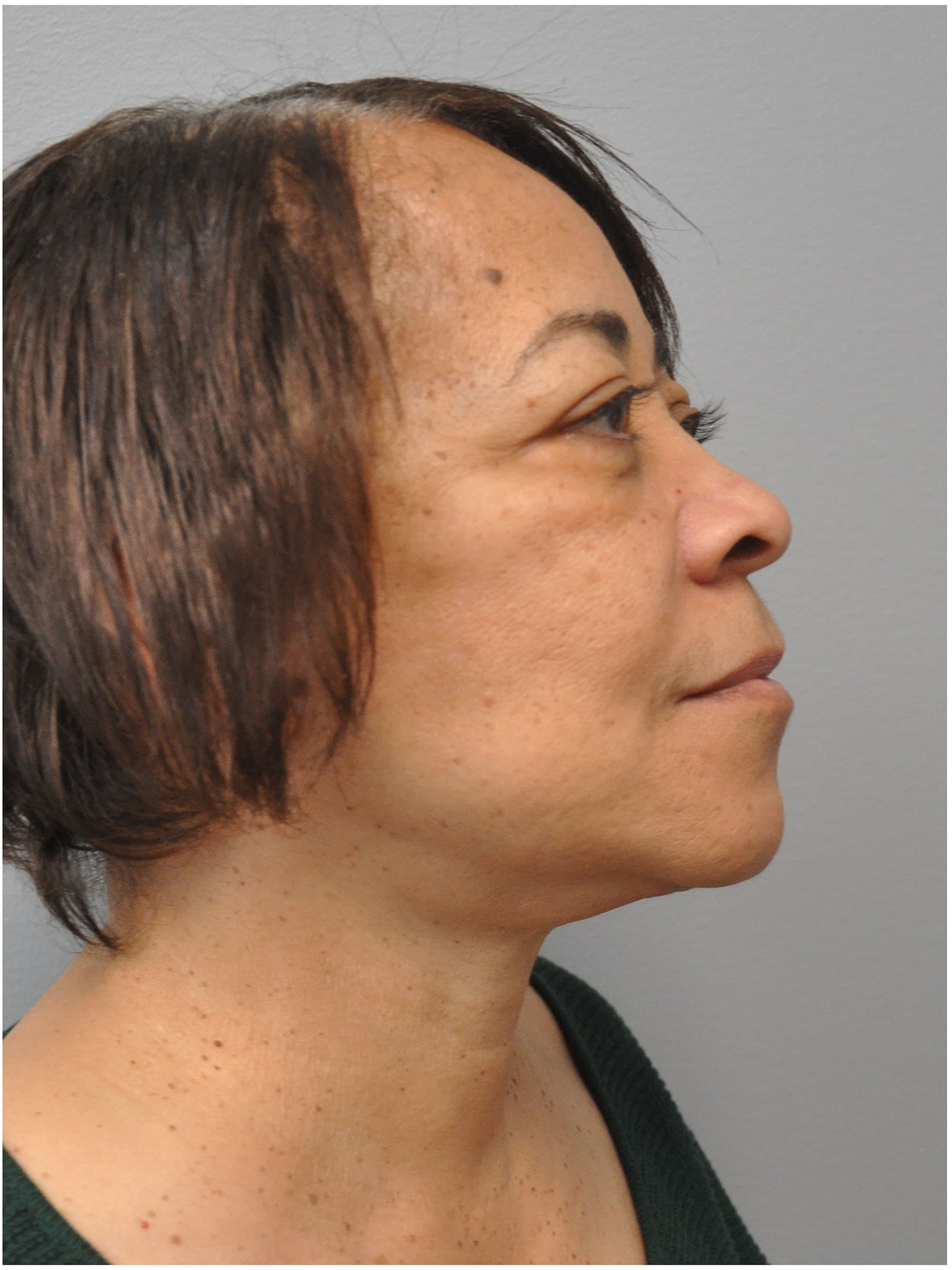 Facelift Before and After | Little Lipo