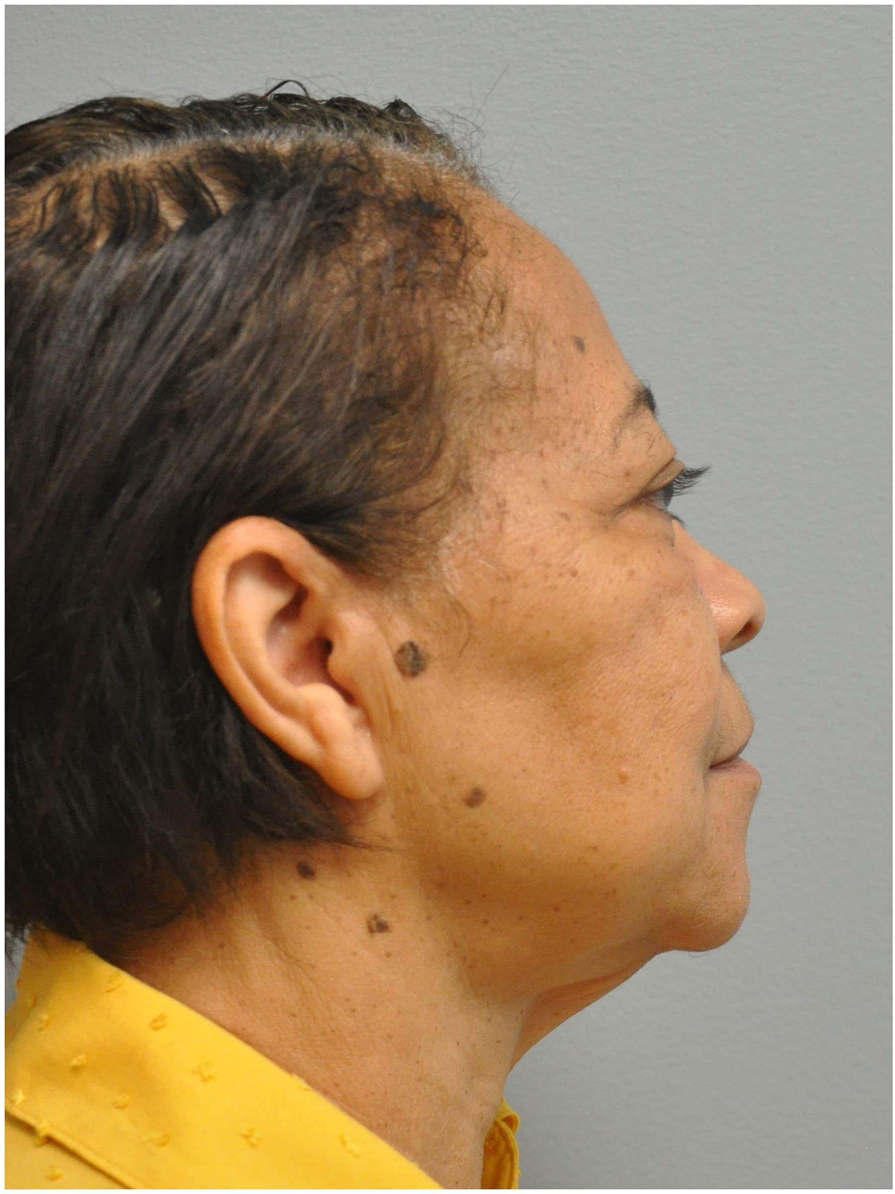 Facelift Before and After | Little Lipo