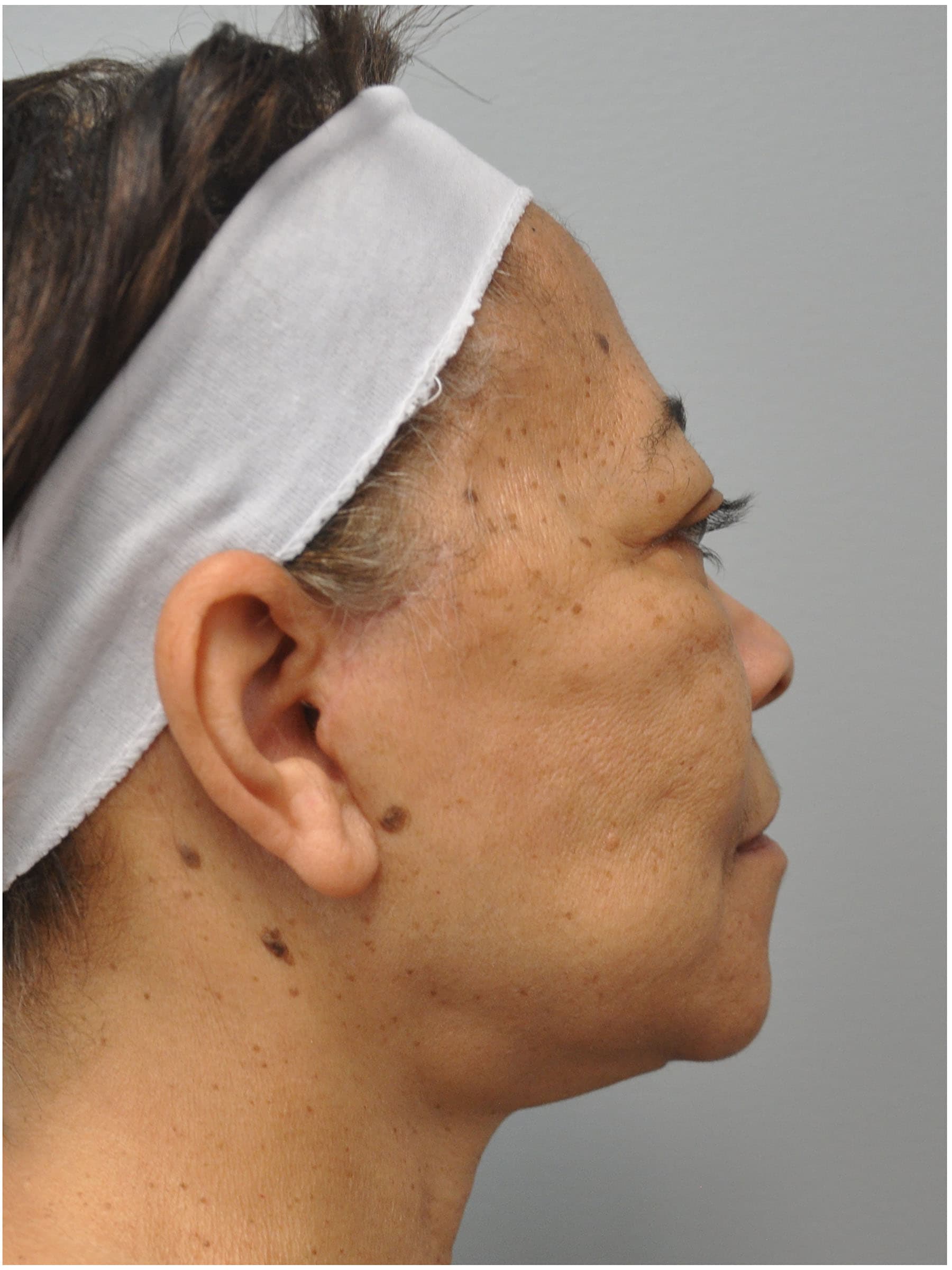 Facelift Before and After | Little Lipo
