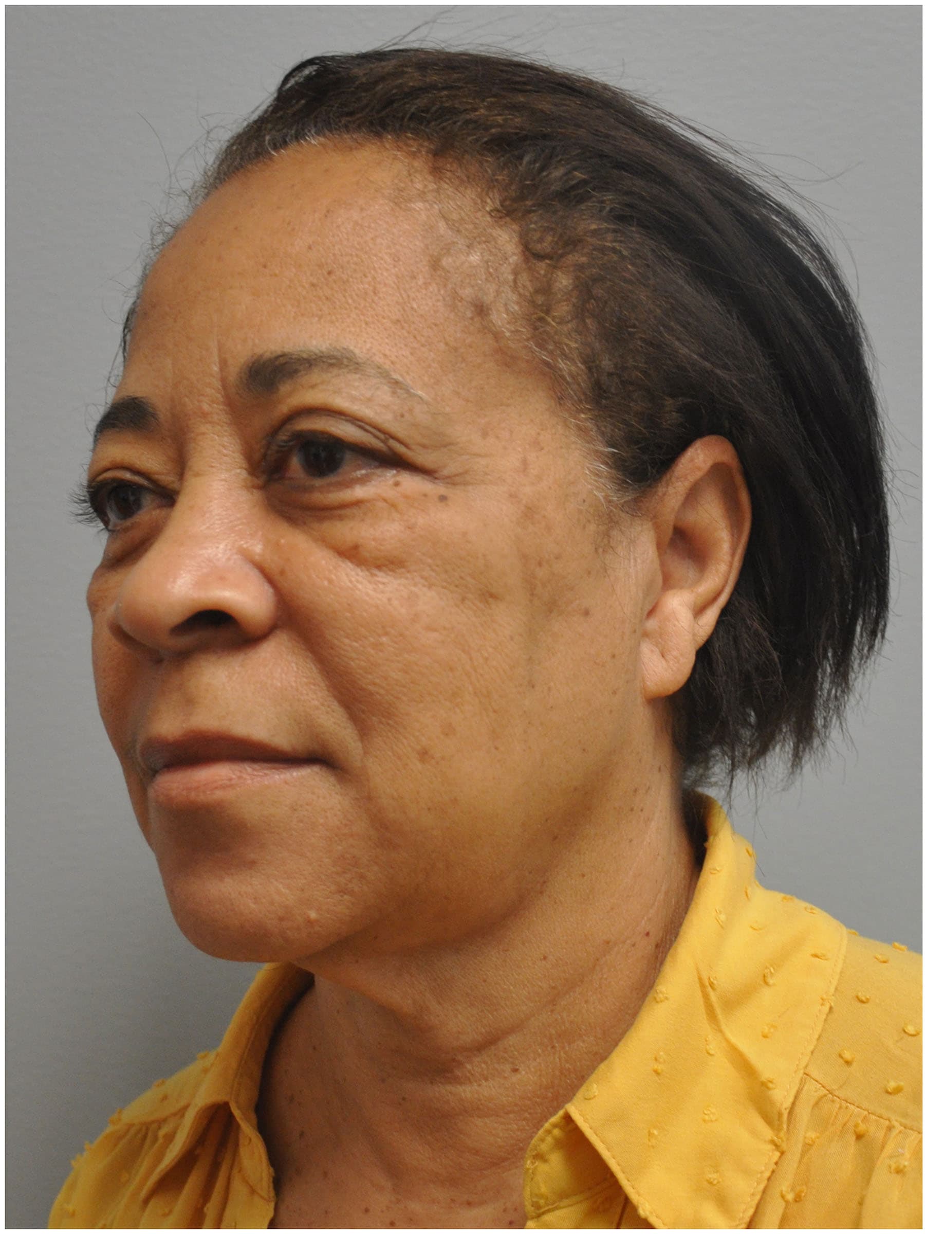 Facelift Before and After | Little Lipo