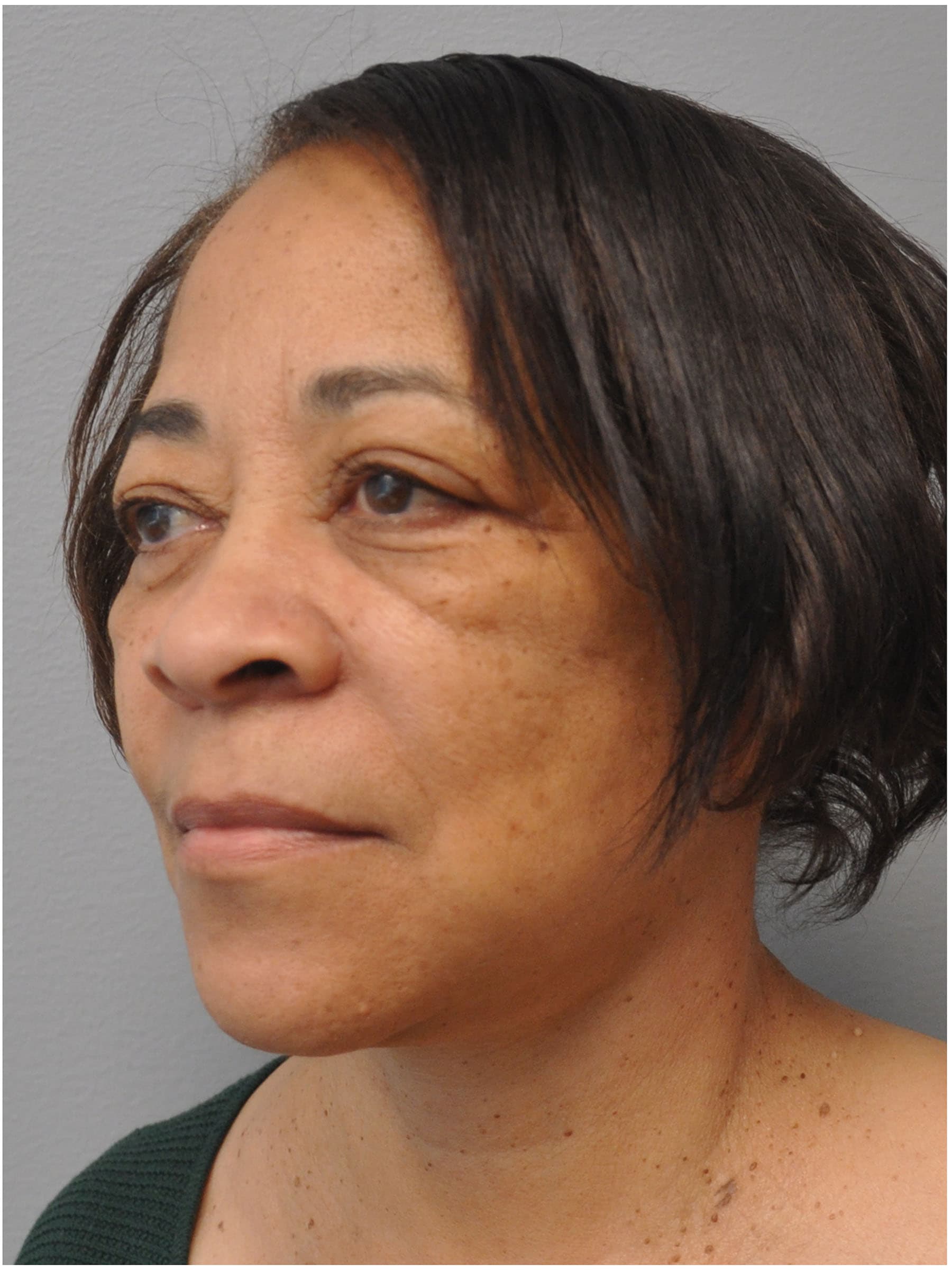 Facelift Before and After | Little Lipo
