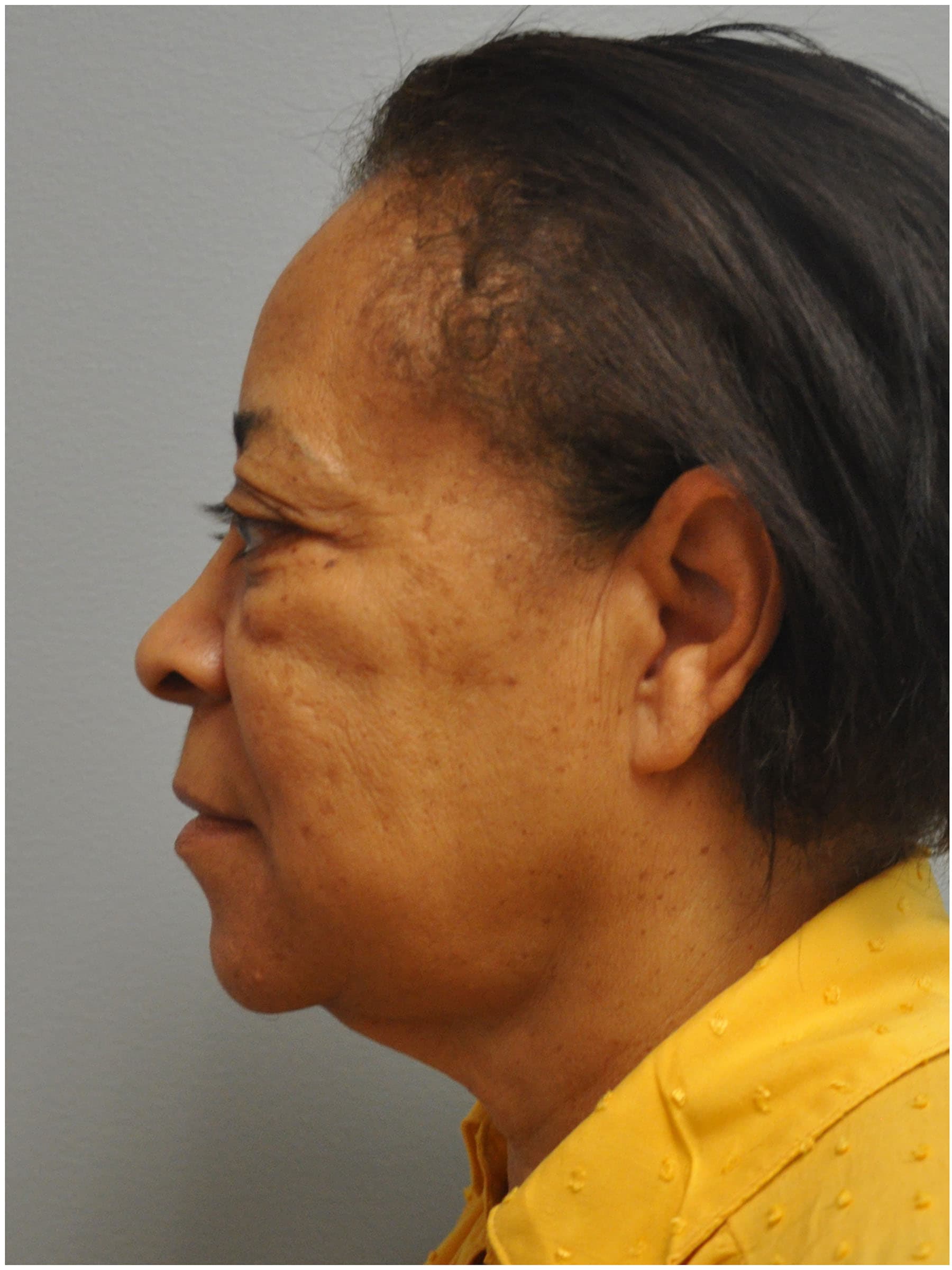Facelift Before and After | Little Lipo