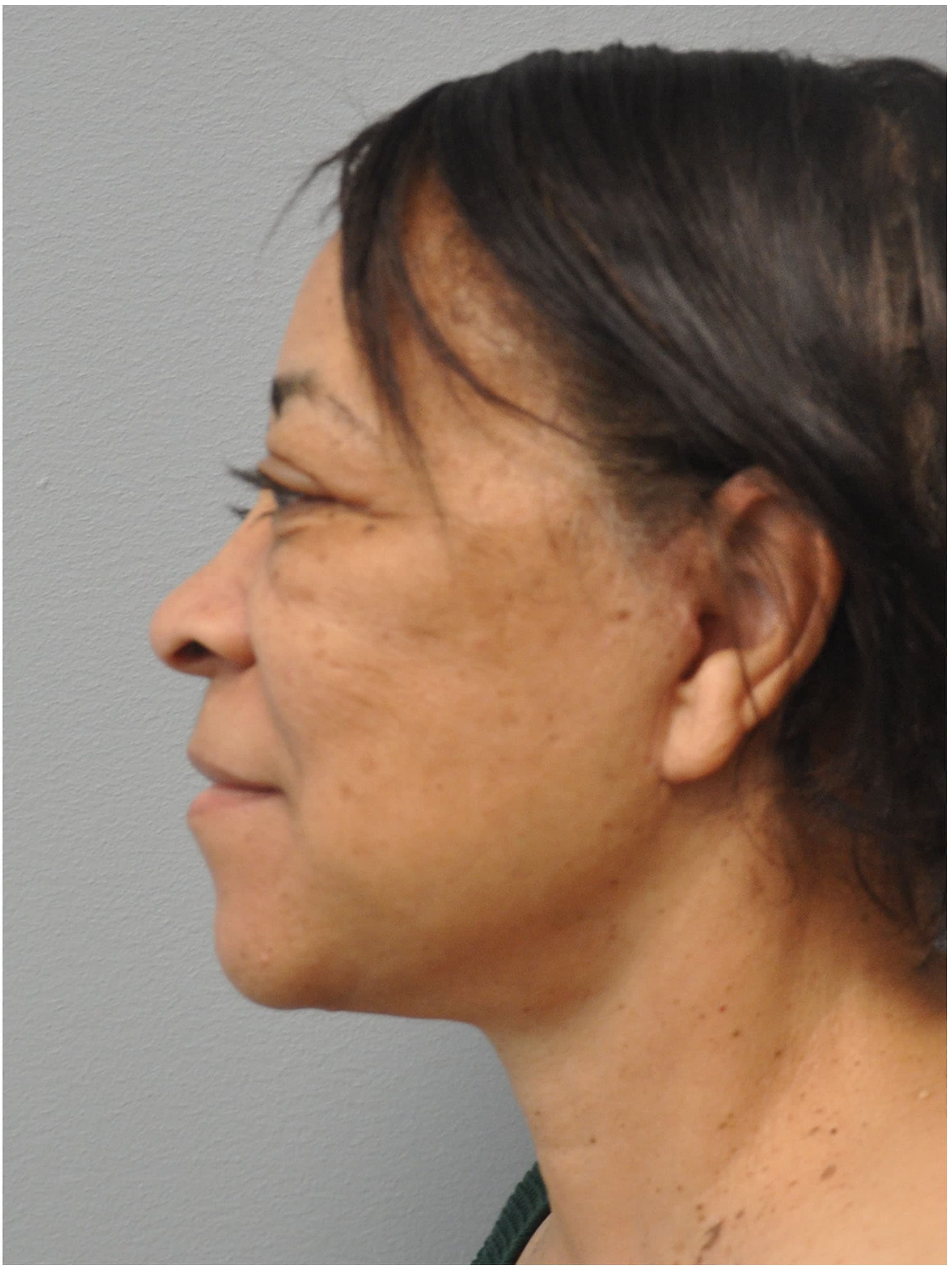 Facelift Before and After | Little Lipo
