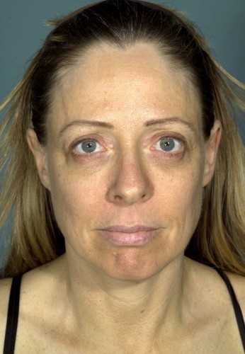 Facelift Before and After | Little Lipo