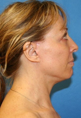 Facelift Before and After | Little Lipo