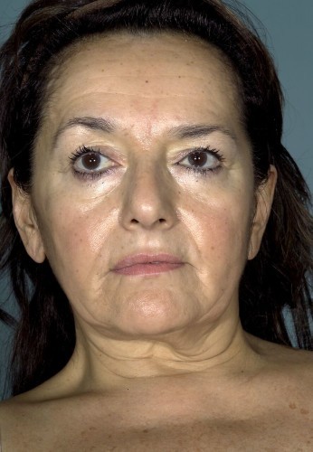 Facelift Before and After | Little Lipo