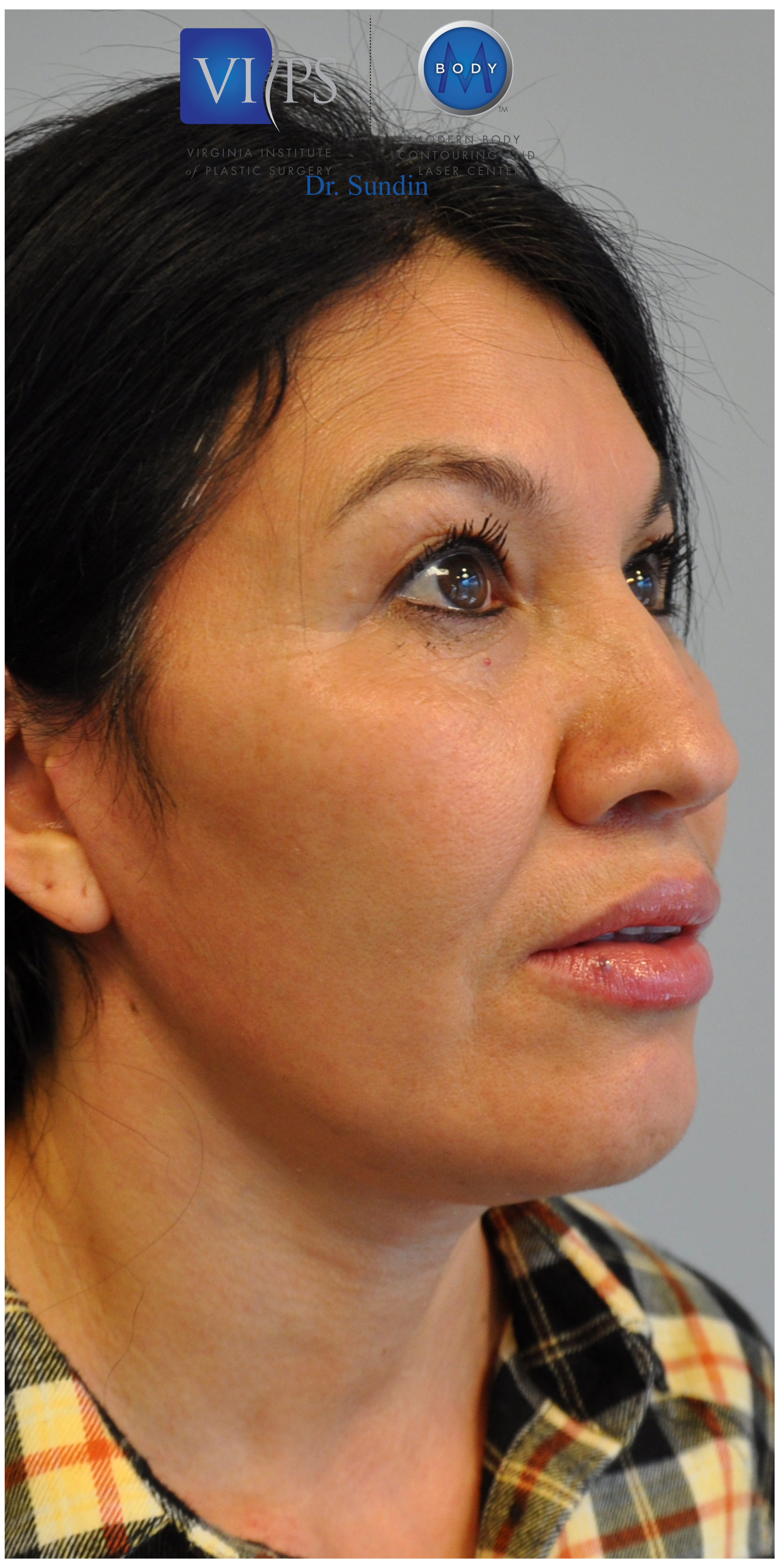 Facelift Before and After | Little Lipo