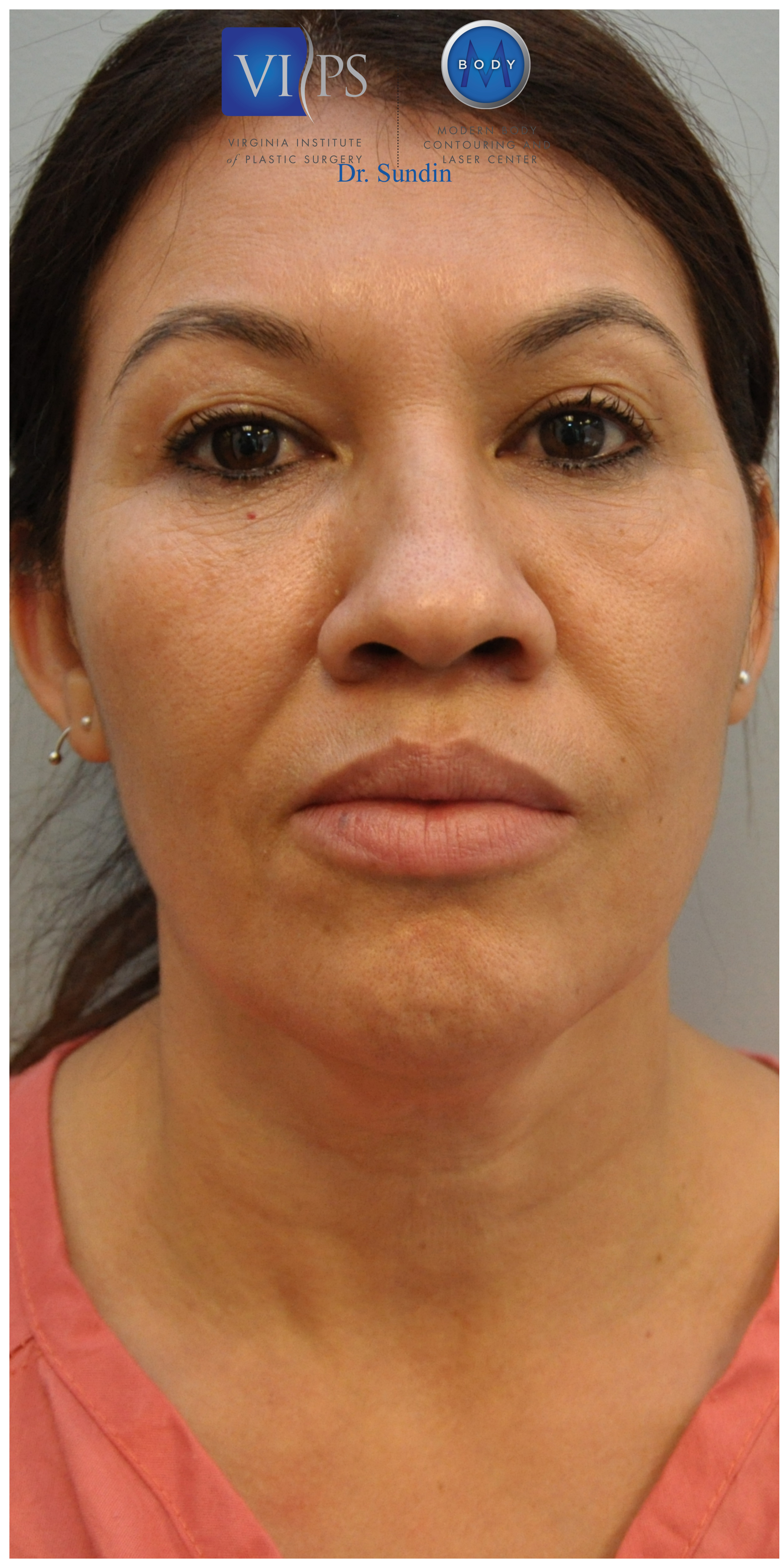 Facelift Before and After | Little Lipo