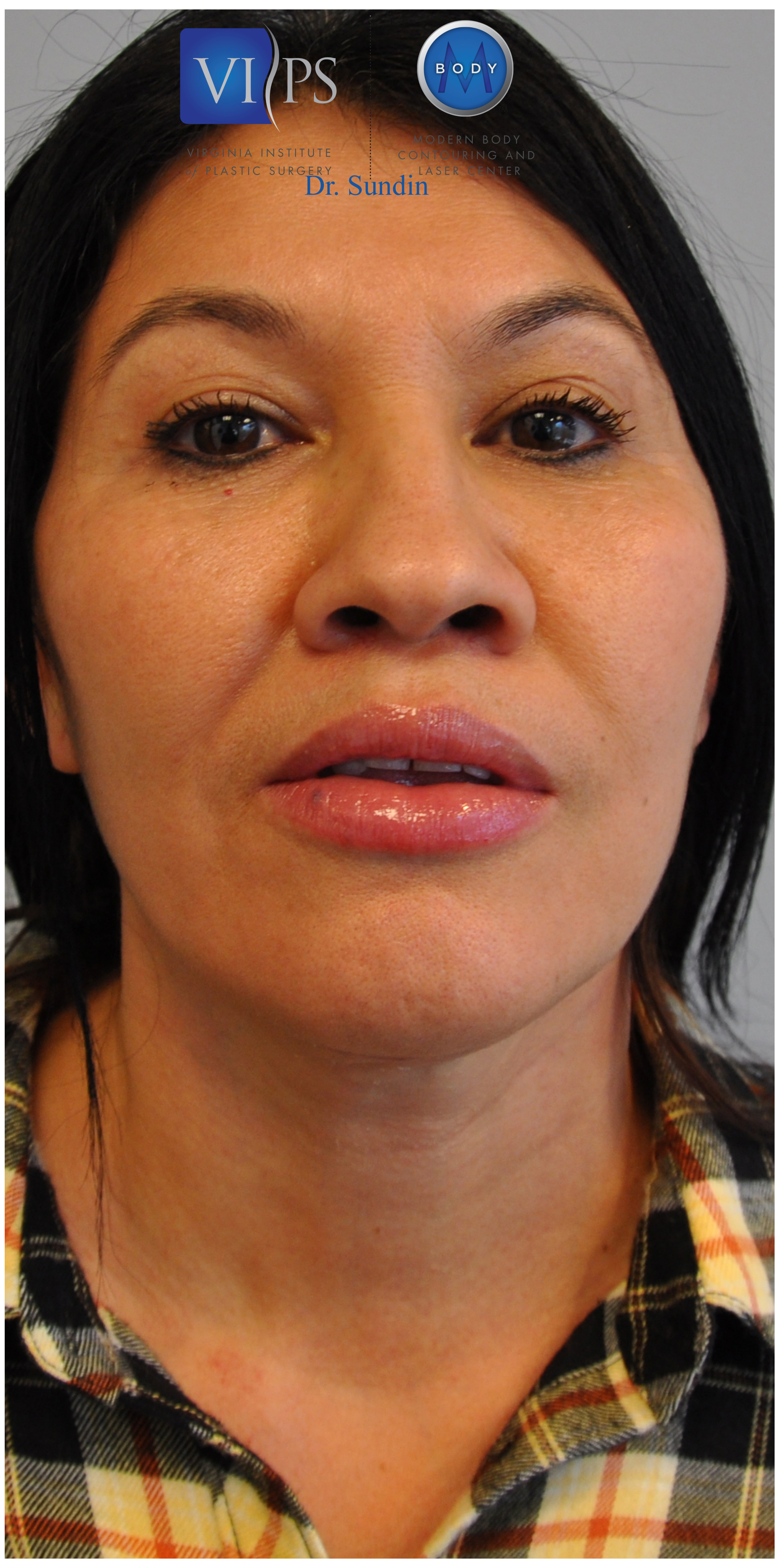 Facelift Before and After | Little Lipo